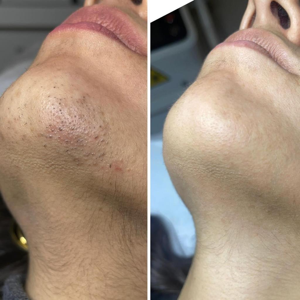 EpilStar — efekt zabiegu 2